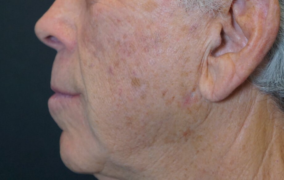 75 Year Old Male Has Ipl For Age Spots Sun Damage Results In Beverly Hills Ca 75 Year Old Male Has Ipl For Age Spots Sun Damage Results In Beverly Hills Ca