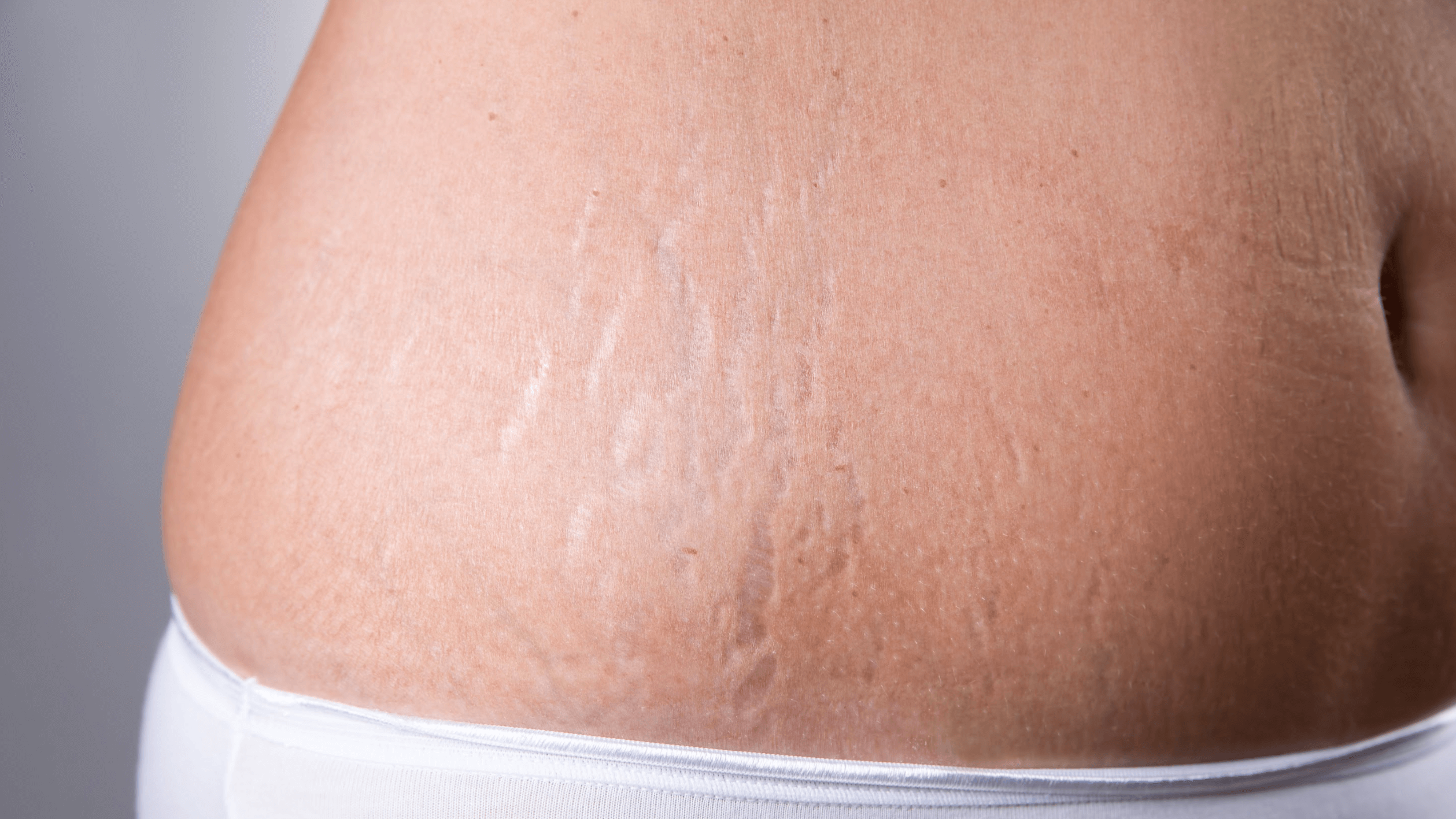 What are stretch marks and what can you do to get rid of them? - ASPS