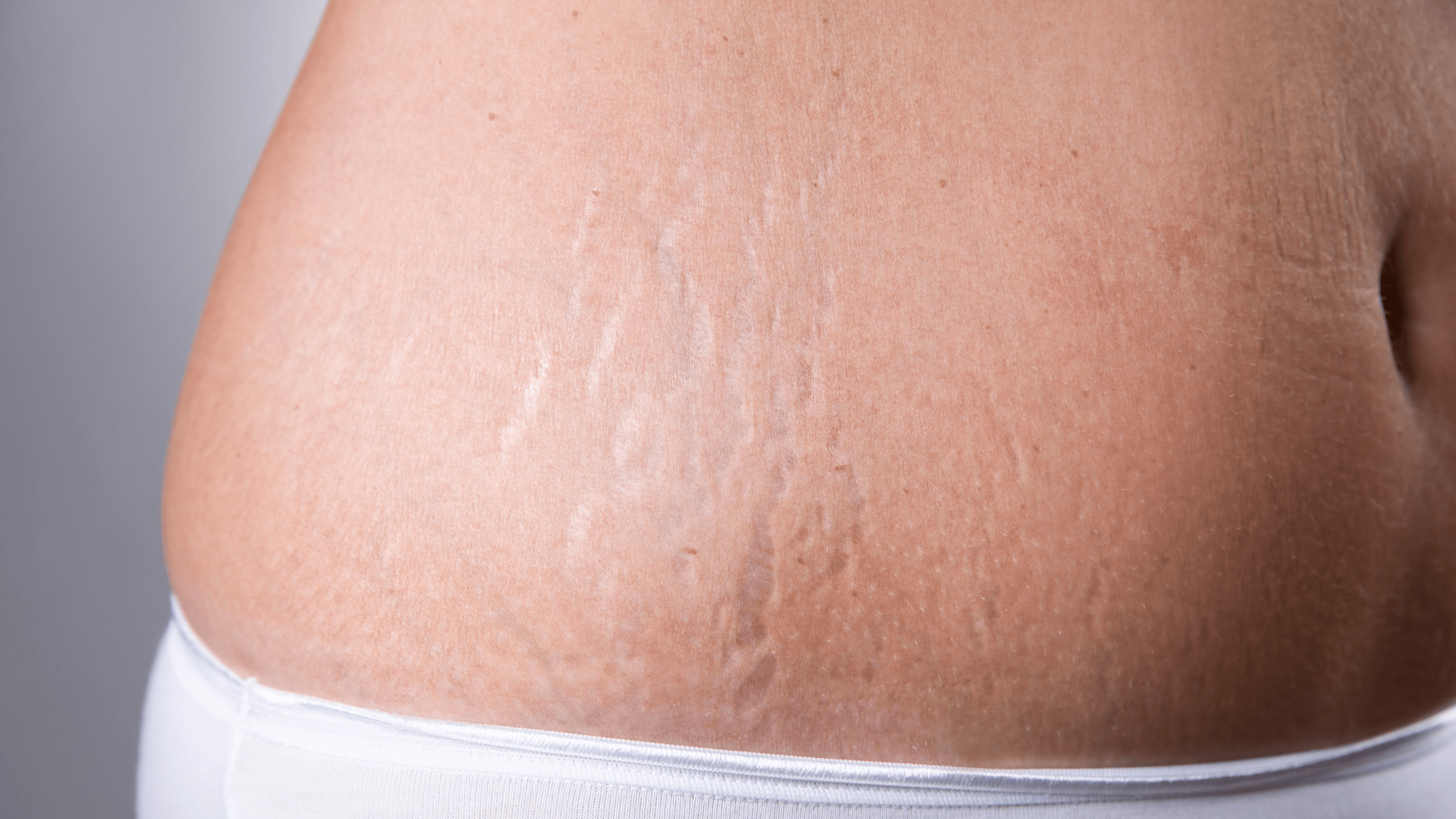 Stretch Mark Removal - Book Free Consultation Online - Miami Skin Spa